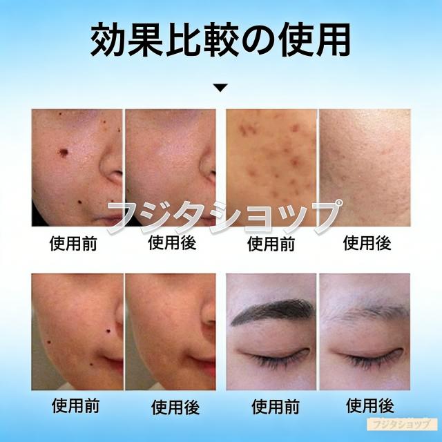 ピコレーザー 美顔器 美容機器 自宅 家庭用 レーザーペン シミ取り